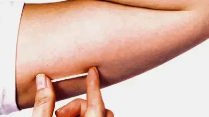 Santa Cruz do Sul passa a disponibilizar implante contraceptivo pelo SUS; saiba como ter acesso